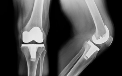 人工膝関節置換手術(TKA)